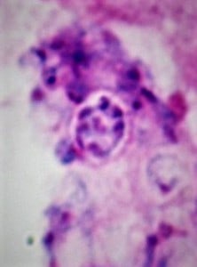 Pneumocystis